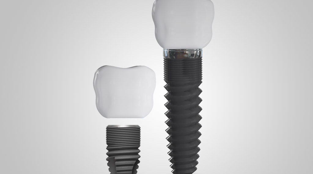 Implantes dentales cortos en Castelldefels
