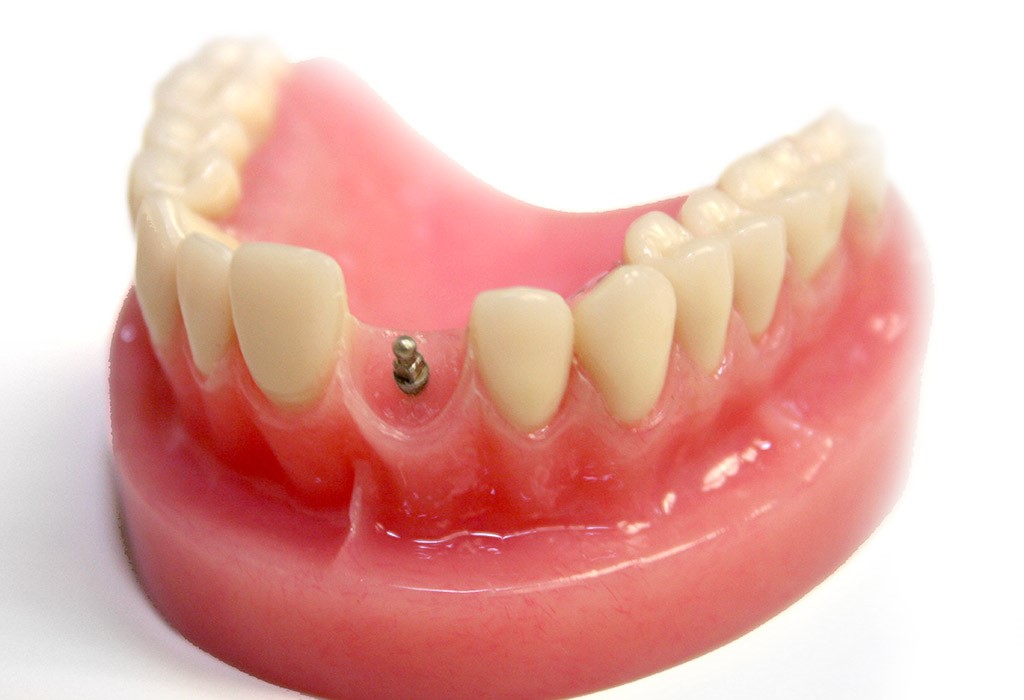 Implantes dentales en Castelldefels