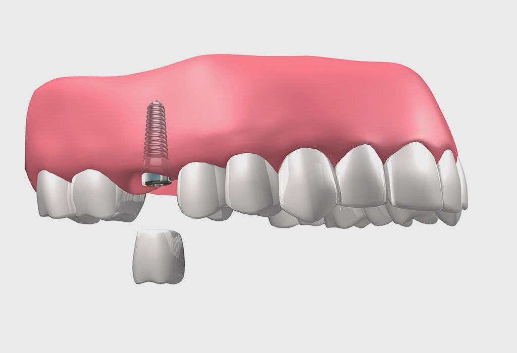 Implantes dentales en Castelldefels